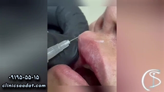 تزریق ژل لب | نکات قبل و بعد از درمان