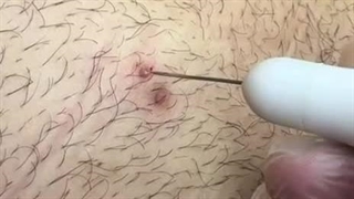 تفاوت کرایوتراپی و پلاسماجت