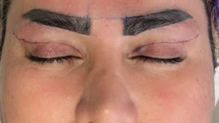 کاشت ابرو با روش به روز sut