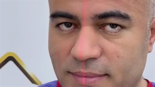 کاشت مو به روش sut در کلینیک  سینا ( رنسانس )