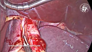 تسلط بر میوتومی هلر با حفظ عصب واگ قدامی در طول میوتومی هلر لاپاراسکوپی