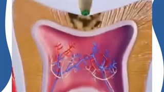 پوسیدگی دندان چگونه به عصب می رسد؟ (ویدئو آموزشی)