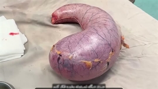 چرا رد منگنه در جراحی مهمه؟
