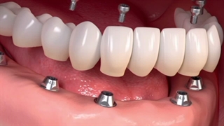 اوردنچر چیست و چه فرقی با کاشت ایمپلنت داره؟
