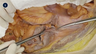 2 Abdominal Exposure - Right Medial Visceral Rotation