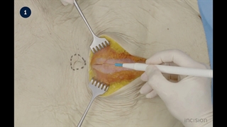 5 Abdominal Wall Incision - Lower Midline