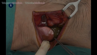 3 Open Transabdominal Right Adrenalectomy - Incision Academy
