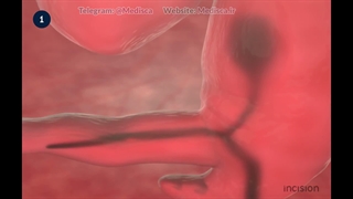 6 Anatomy - Embryological Rotation of the Midgut