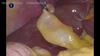 17 Laparoscopic Cholecystectomy