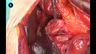 41 Open Hepaticojejunostomy