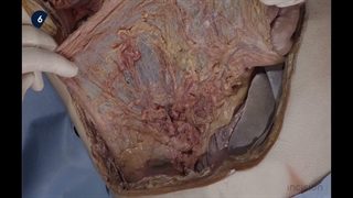 42 Open Left Colectomy - Medial to Lateral