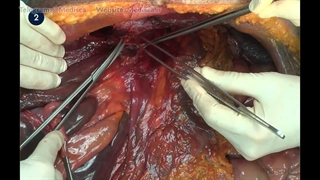 43 Open Left Hepatectomy