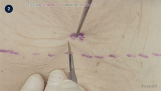 44 Open Loop Ileostomy