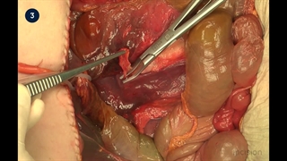 48 Open Pylorus Preserving Pancreaticoduodenectomy (PPPD)