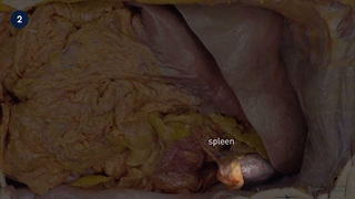 56 Open Splenectomy
