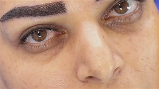 کاشت ابروی طبیعی در کلینیک سینا همان رنسانس معروف