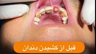 کاشت دندان در یک روز