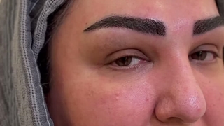 کاشت ابروی سوپرنچرال در کلینیک سینا همان رنسانس معروف