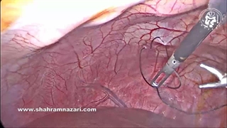 بخیه قله کیسه صفرا برای تسهیل عمل جراحی در لاپاراسکوپی با سه پورت