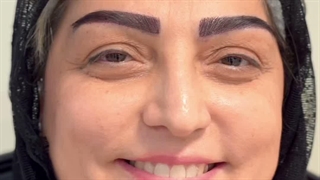 کاشت ابرو به روش سوپر نچرال