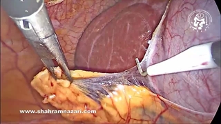 شکل کلاه فینیقی کیسه صفرا: یک آناتومی چالش برانگیز است